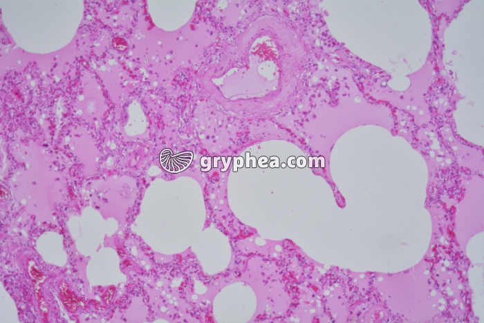 Poumon de fumeur x25 - gryphea.com